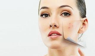 痘印怎么消除小妙招 痘印怎么消除小妙招